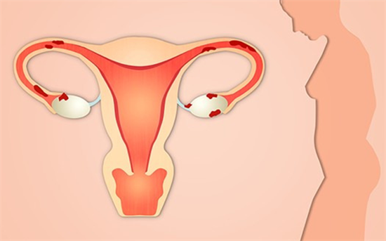 子宫腺肌症最好的治疗方法是什么？子宫腺肌症会导致女性不孕吗