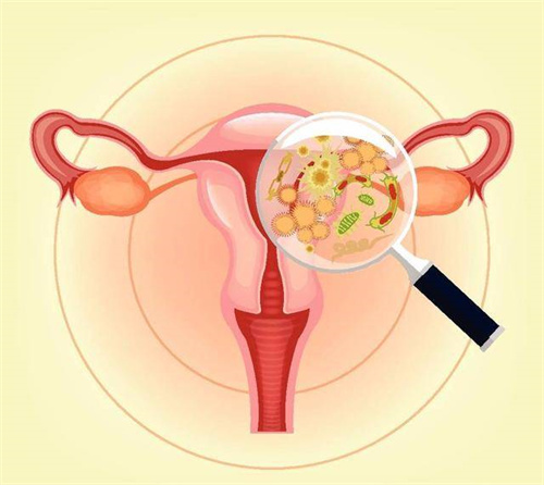 子宫出血的症状？排卵障碍性子宫出血的最佳治疗方法是什么？