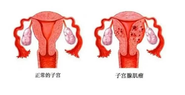 在潮州市中心医院做试管要花多少钱？