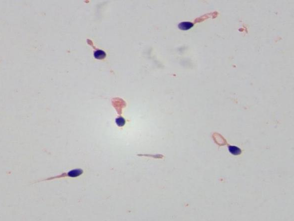 子宫内膜增厚和宫外孕，到底有没有关系？