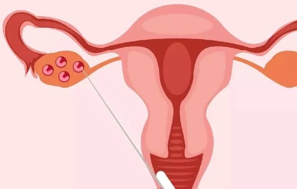 做三代试管到底有多难受