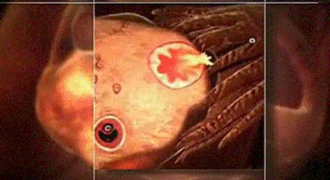   供卵试管婴儿适合哪些情况